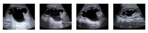 Antenatal Hydronephrosis Benign Finding Or Congenital Anomaly Of The Kidney Urinary Tract Nyu Langone News