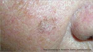 Melanoma is the most dangerous t. Skin Cancer Pictures Photos Pictures Of Skin Cancer