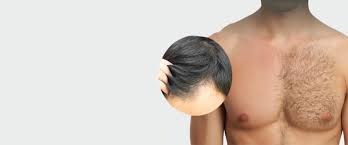 Check spelling or type a new query. Bht Body Hair To Head Transplant At Aura Skin Institute Chandigarh India