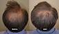 Minoxidil 5 Beard