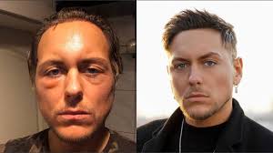Check spelling or type a new query. Fazit Meiner Haartransplantationen Kosten Vorher Nacher Bilder Und Ergebnis Teil 2 Youtube