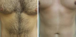 Shave here, trim there, and leave. Laser Hair Removal For Men In Leeds And Bradford Good Skin Days
