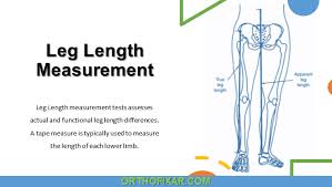 Image result for Functional Leg Length Discrepancy
