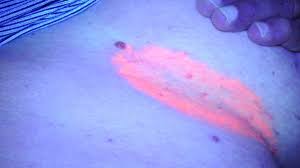 Image result for Erythrasma