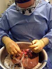 Then the surgeon connects your blood vessels and bile ducts to the donor liver. Liver Transplantation Conditions And Treatments Center For Liver Disease Transplantation Columbia University Department Of Surgery