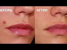 How To Remove Moles On Face At Home Diy 5 Home Remedies For Mole Removal By Desi Beauty Tv Youtube Moles On Face Laser Mole Removal Mole Removal