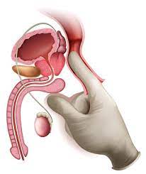 Check spelling or type a new query. Prostata Untersuchung Behandlung Wirkung Risiken Gesundpedia De