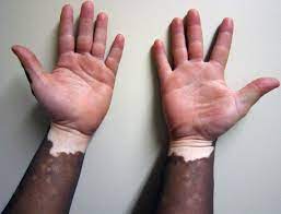 File:Vitiligo1.JPG - 维基百科，自由的百科全书