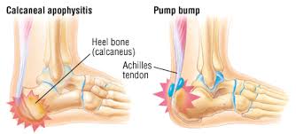In this article i'll explain what happens to your tendon when you injure it and why it forms this lump. Heel Pain Harvard Health