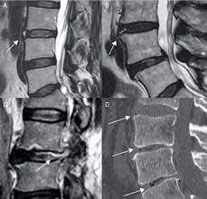 Annular Tears Sagittal T2 Weighted Mri Shows A Concentric A Download Scientific Diagram
