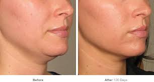 Here are the factors that cause the issue and prevention tips. How Laser Skin Tightening Works Radiofrequency Skin Treatment Details