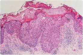 Thank you, {{form.email}}, for signing up. Bowen S Disease Signs And Symptoms