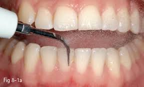 Tooth Discoloration Pocket Dentistry