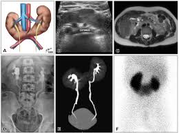 Beautiful Multi Modality Imaging Of A Horseshoe Kidney Http Radiopaedia Org Articles Horseshoe Kidney Pet Ct Radiology Nuclear Medicine