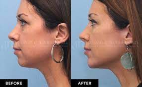 Pearlman suggests the thinnest hyaluronic acid fillers, juvederm or restalyne silk, which last anywhere from six to nine months. Longevity Of Dermal Fillers Guide San Francisco Dr David C Mabrie Mabrie Facial Institute