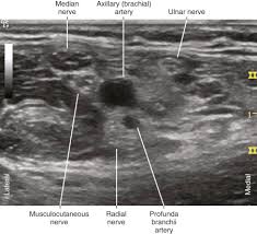 Image result for Axillary Nerve Block