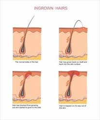 Ingrown hairs are a small balls which are infected, that did not grow or they were removed incorrectly. Types And Causes Of Folliculitis