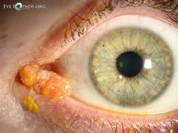 Image result for Centrostigma papillosum