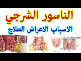 الناسور اسبابه اعراضة وعلاجه موضوع شامل Youtube