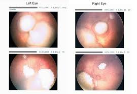 Defining the relationship of the symptoms to the disease can defuse fear and encourage a sense of control in patients and their families. Retinoblastoma Wikipedia