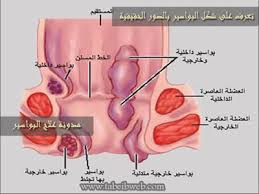 البواسير Hemorrhoid مركز وليد الكدس الطبي للعلاج الطبيعي Facebook