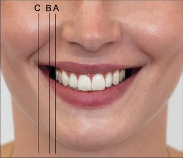 The perception of facial esthetics with regard to different buccal corridors  and facial proportions - APOS Trends in Orthodontics