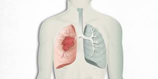 Anyone can get lung cancer. What Is Lungs In Spanish