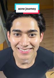 Kunci Sembuh Jerawat dengan Face Wash yang Gentle