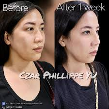 PAHELP PLS ANO PO MAS BETTER SILICON,GOROTEX OR CARTILAGE GOROTEX??