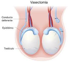 Vasectomia, cunoscuta si sub numele de sterilizare masculina, este procedura medicala prin care. Como Se Realiza La Vasectomia Tu Canal De Salud