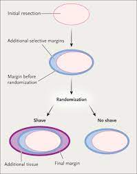 A positive margin means that cancer cells come right out to the edge of the removed tissue and have ink on them. A Randomized Controlled Trial Of Cavity Shave Margins In Breast Cancer Nejm