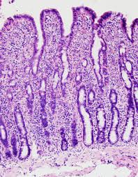 Tobacco smoke contains many chemicals that are known to cause lung cancer. Inflammatory Bowel Disease Cornell University College Of Veterinary Medicine