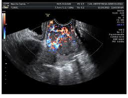 A doppler ultrasound is a quick, painless way to check for problems with blood flow such as deep vein thrombosis (dvt). Transvaginal Color Doppler From A Cervical Cancer Showing An Abundant Download Scientific Diagram