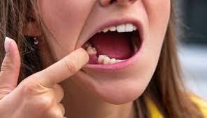 Seeing increasing numbers of covid tongues and strange mouth ulcers. Covid 19 Long Haulers Report Unusual Oral Symptoms Decisions In Dentistry