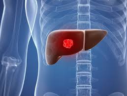 Spinal cord compression occurs because the tumor starts pressing hard against your spinal cord. Sir Spheres To Treat Liver Metastases Prostate Cancer