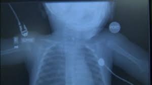 Cameron Herrick 5 Month Old Baby Saved After Almost Dying From Choking On Pacifier Huffpost Life