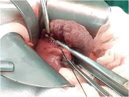 A phyllodes tumour is a growth of cells that forms a hard lump in the breast. A Giant Malignant Phyllodes Tumor Of Breast Post Mastectomy With Metastasis To Stomach Manifesting As Anemia A Case Report And Review Of Literature Bmc Surgery Full Text