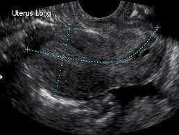 Gallery For Uterus Anatomy Ultrasound Obstetric Ultrasound Ultrasound Medical Ultrasound