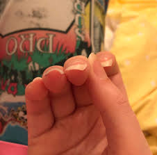 Concave upward is also called. Why Do Some Of My Nails Bend Downwards On One Side And How Do I Fix It Pls Used To Be Able To Grow Such Nice Nails So This Is Annoying Nails