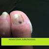 Tengo una infección por hongos en las uñas, ¿cuánto tiempo tomará para que mi uña vuelva a la normalidad? 1