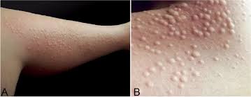 Test must be activated on hairconfirm and laboratory fee must be paid prior to shipping to the lab. Follicular Traction Urticaria A New Form Of Chronic Inducible Urticaria Html Acta Dermato Venereologica