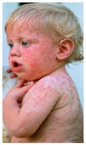 Image result for Rubella
