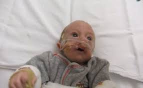 Trisomy 18 child defies expectations and thrives