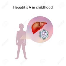 Hepatitis a is a type. Hepatitis A In Childhood Liver Inflammation Medical Anatomy Illustration Lizenzfreie Fotos Bilder Und Stock Fotografie Image 141434957