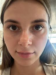 Plexaderm caused severe wrinkles, what to do?