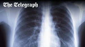 Image result for lung cancer xray