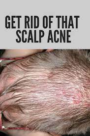 Pin On Diy Hair Growth