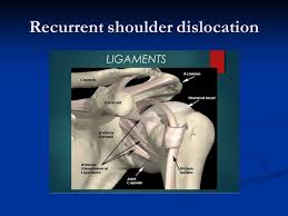 Image result for Chronic Shoulder Dislocation