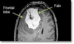 Meningioma Brain Tumor