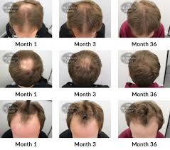 These medicines not only stop hair fall and stimulate hair growth but are also known to make hair cortisone is a steroid. Hair Growth Success Story I Can T Recommend The Belgravia Centre Enough